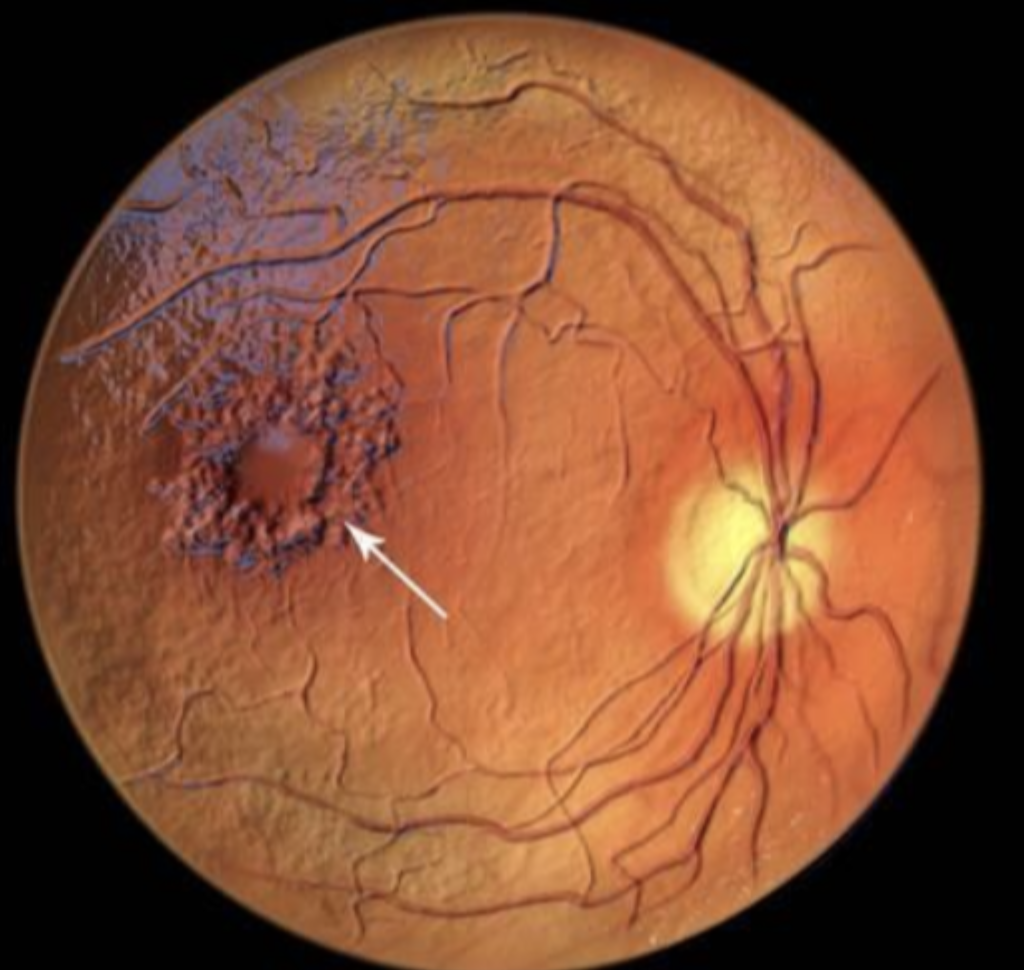 Retinopatía diabética